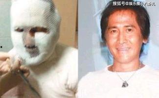 明星拔罐图片,拔罐疗法的时尚演绎